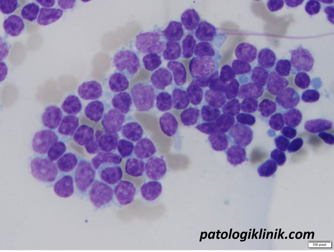 Chronic Lymphocytic Leukemia/Prolymphocytic Leukemia (CLL/PLL)