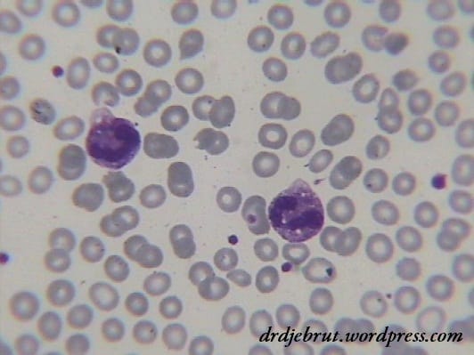 Neutrofil dengan Granulasi Toksik Menandakan Infeksi