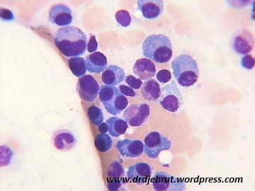 Nyeri Tulang? Hati-hati Multiple Myeloma
