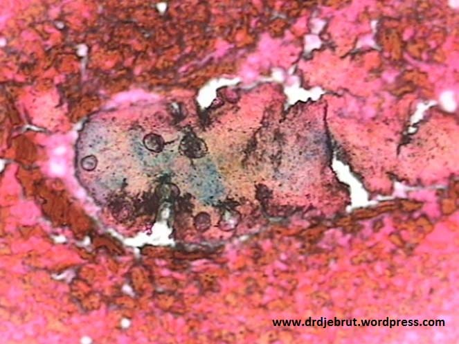 Gambaran Cadangan Besi pada Aspirasi Sumsum Tulang