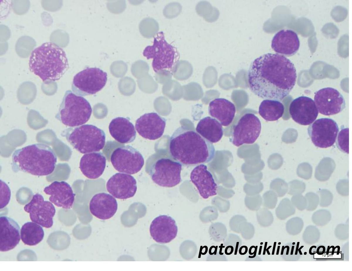 Cara Menentukan Kriteria Remisi AML