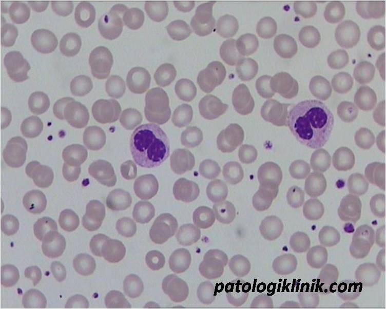 Gambaran Apusan Darah Tepi pada Myelodysplastic Syndrome (MDS)