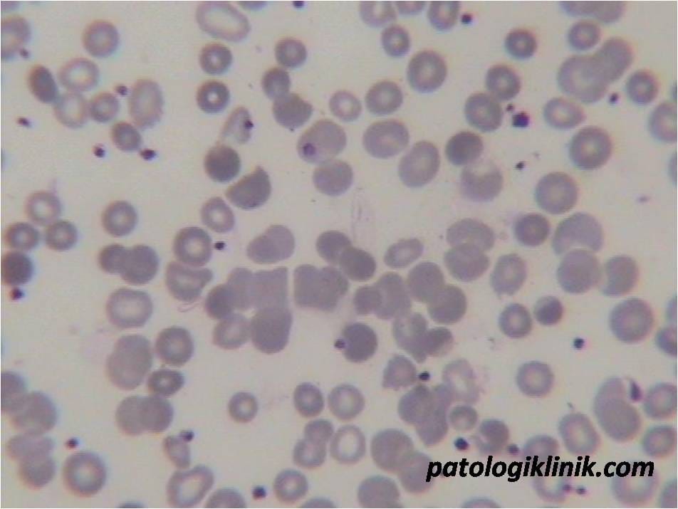 Gambaran Autoaglutinasi pada AIHA