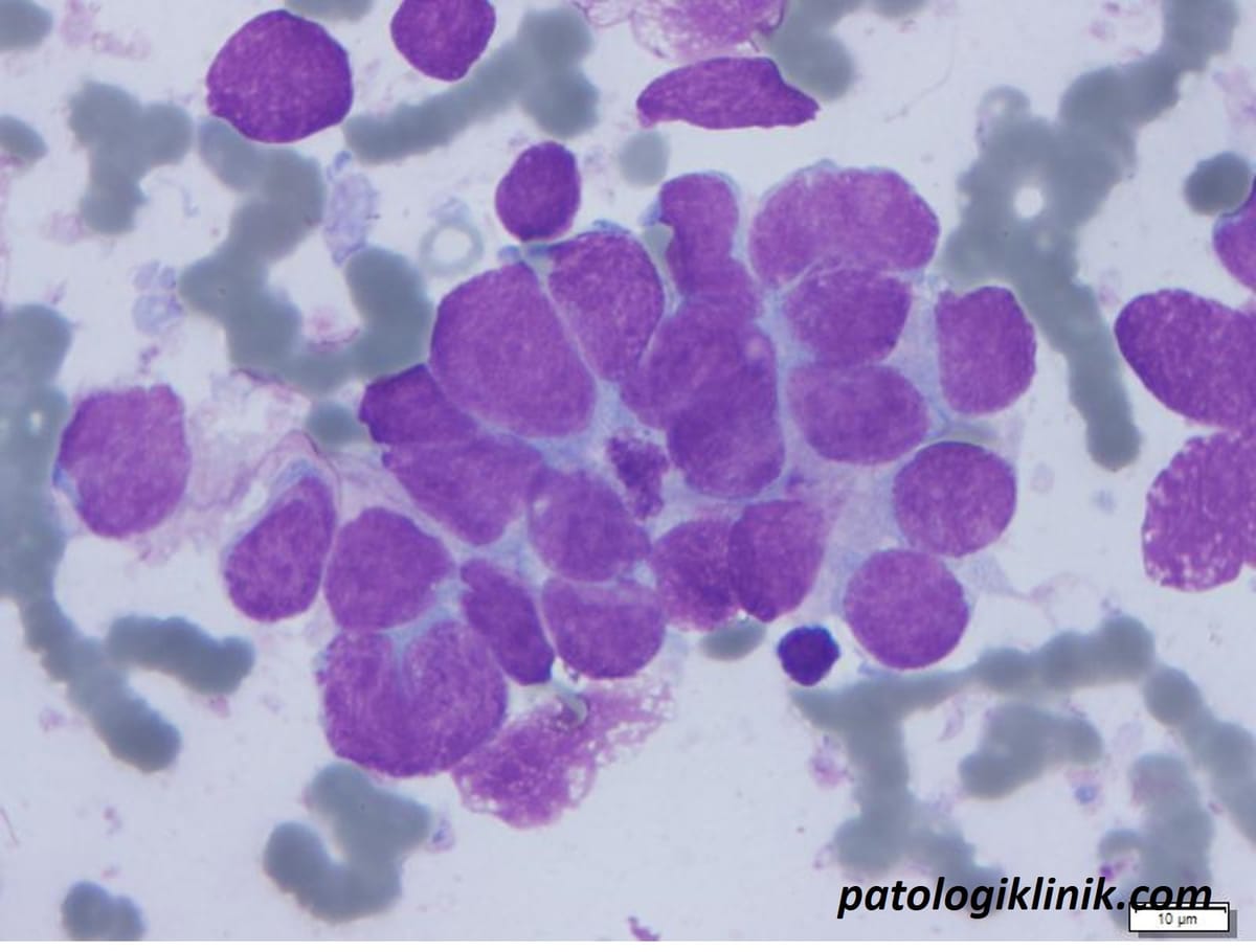 Neuroblastoma pada Sumsum Tulang