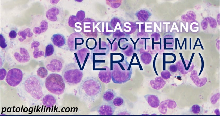 [Infografik] Sekilas Tentang Polycythemia Vera