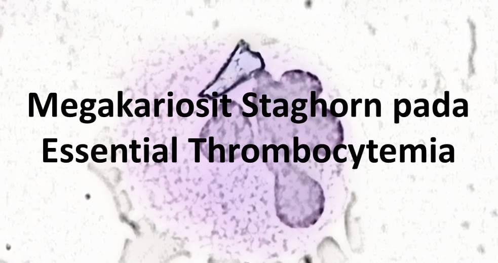 Megakariosit Staghorn pada Essential Thrombocytemia