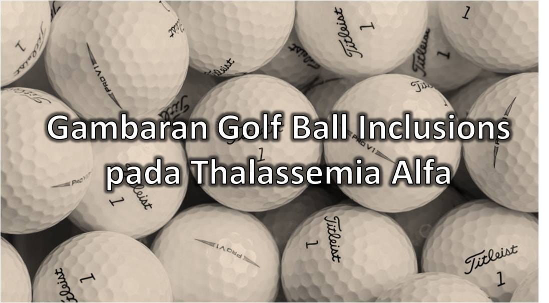 Gambaran Golf Ball Inclusion pada Thalassemia Alfa