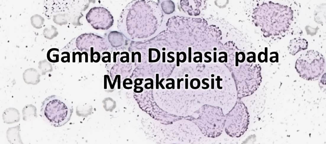 Gambaran Displasia pada Megakariosit