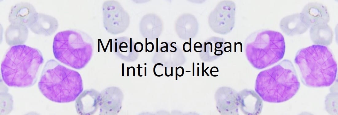 Mieloblas dengan Inti Cup-like