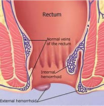 hemorrhoid