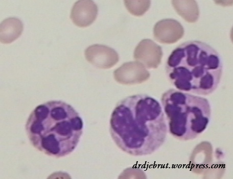 neutrofil hipersegmentasi