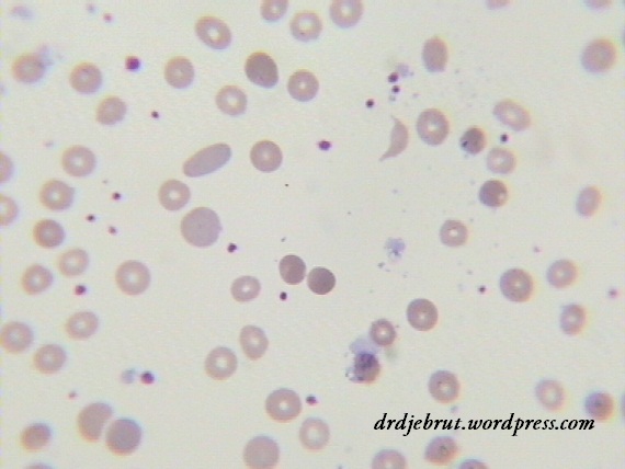 hapusan darah pada AIHA