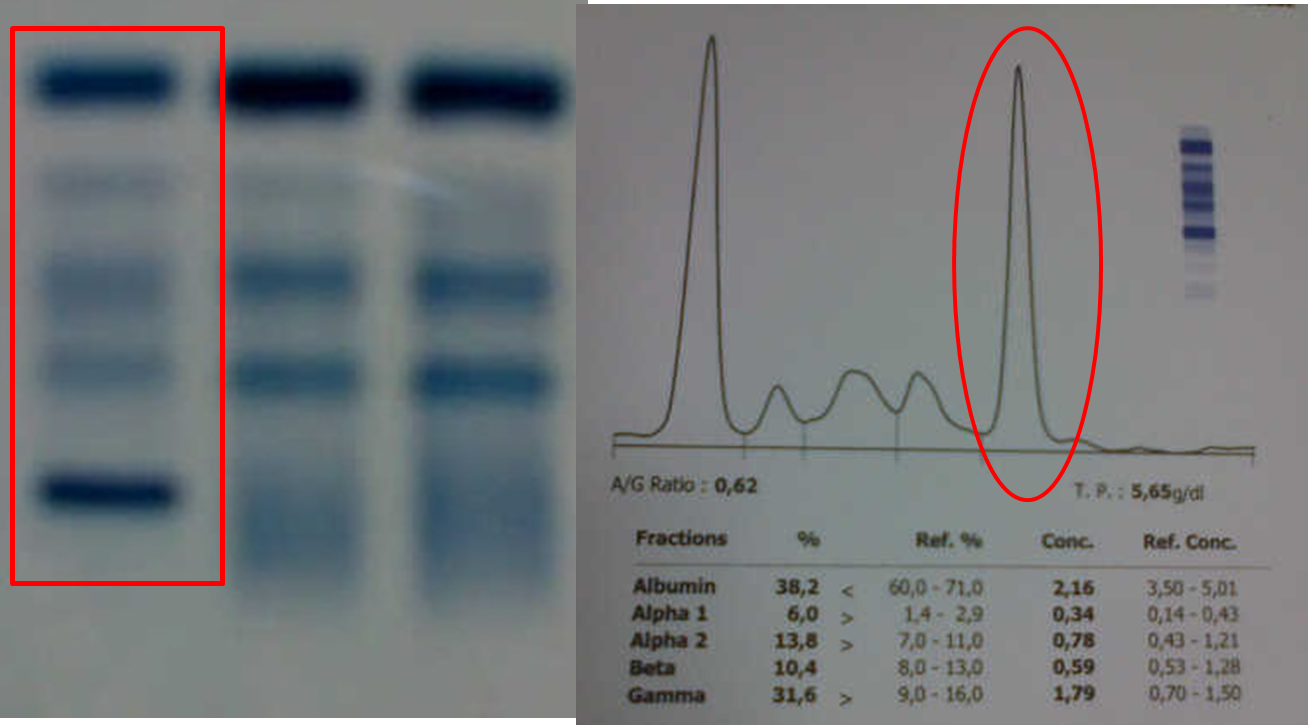 Elektroforesis Protein pada Multiple Myeloma