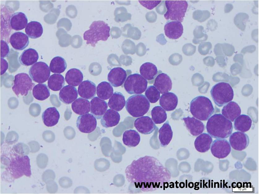 Leukemia Limfoblastik Akut L1 (ALL-L1)