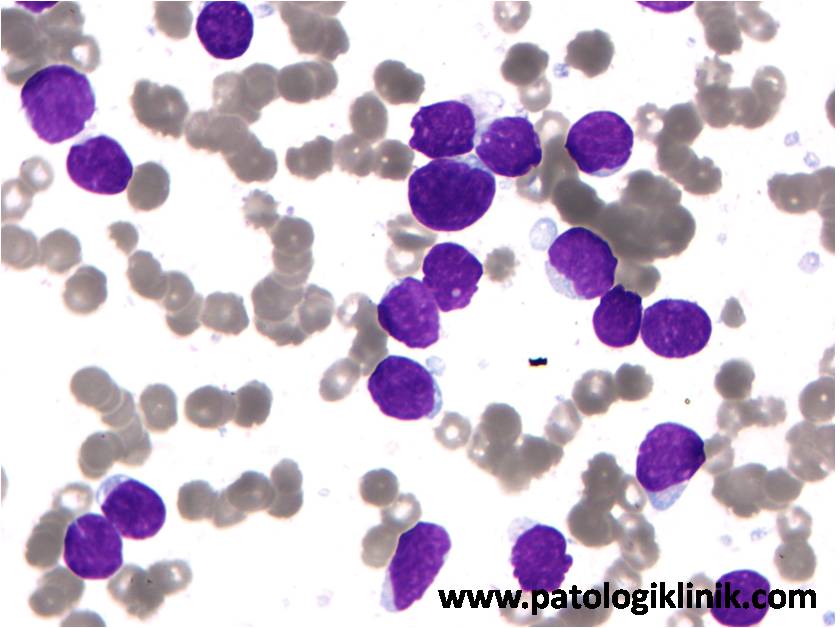 Leukemia Limfoblastik Akut L2 (ALL-L2)