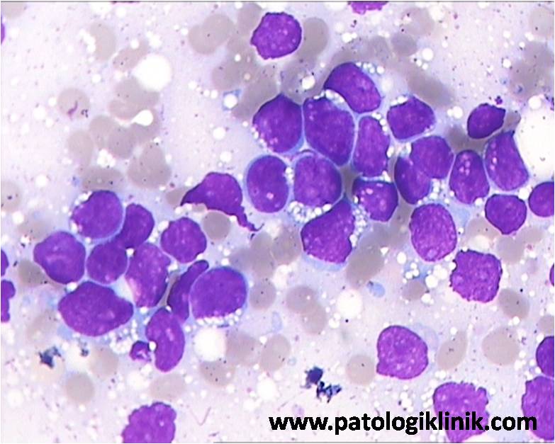 Leukemia Limfoblastik Akut L3 (ALL-L3)