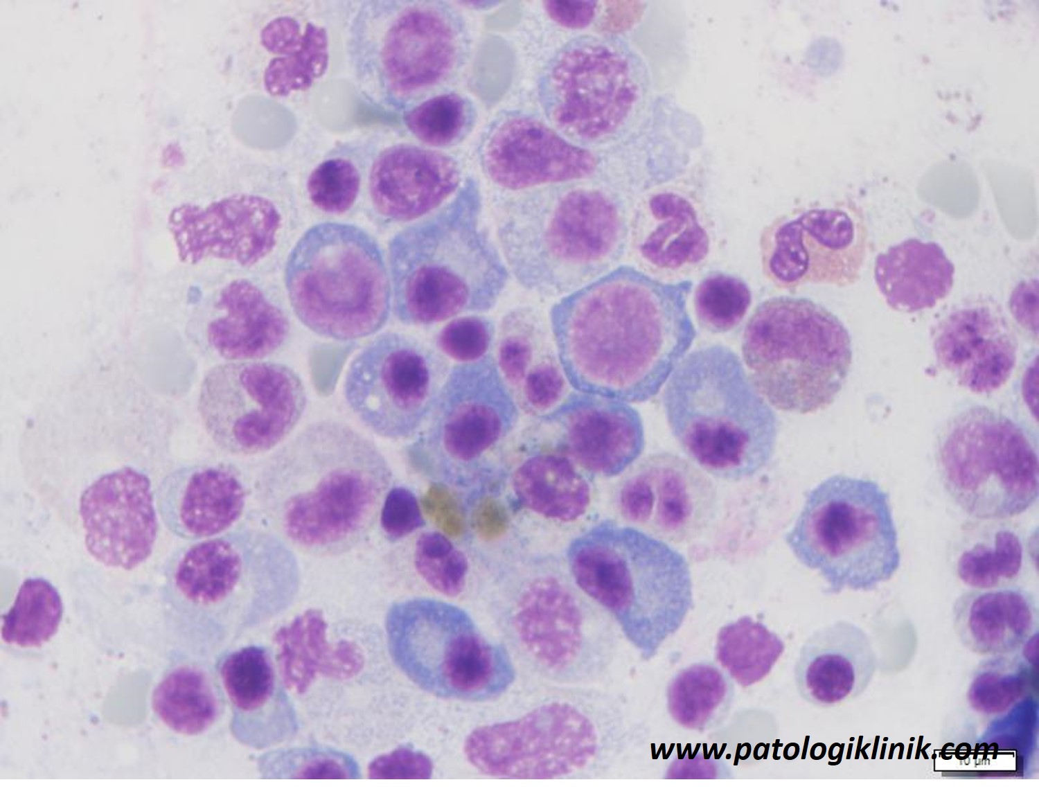 Multiple Myeloma