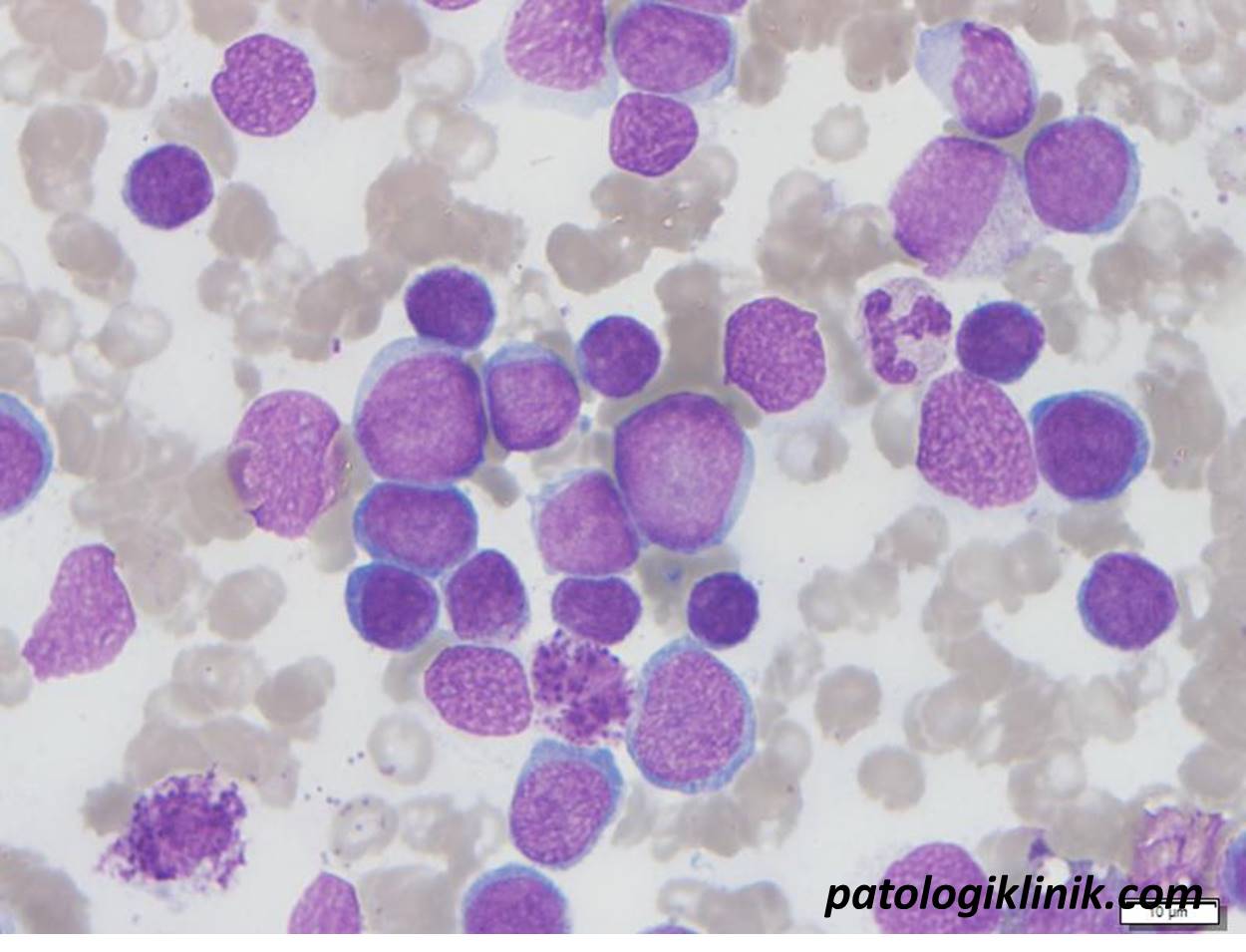 CML Fase Krisis Blast