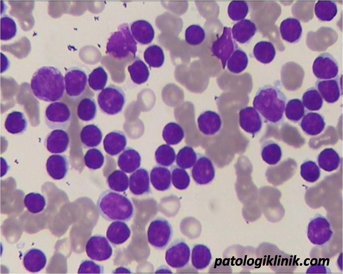 Chronic Lymphocytic Leukemia (CLL)