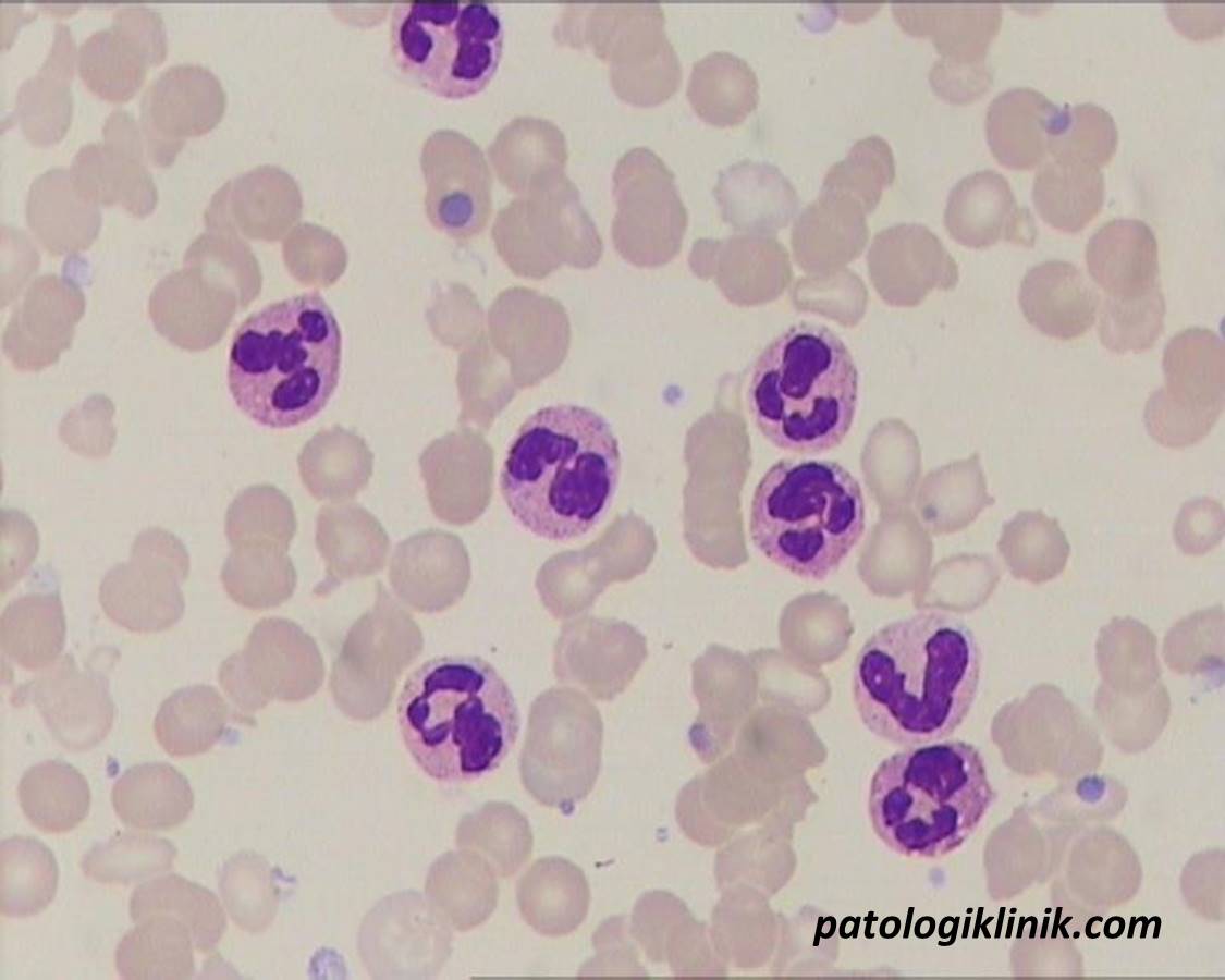 Chronic Neutrophilic Leukemia (CNL)