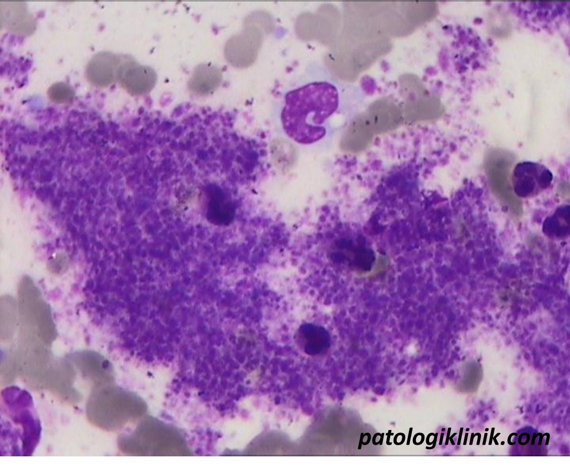 Essential Thrombocytemia