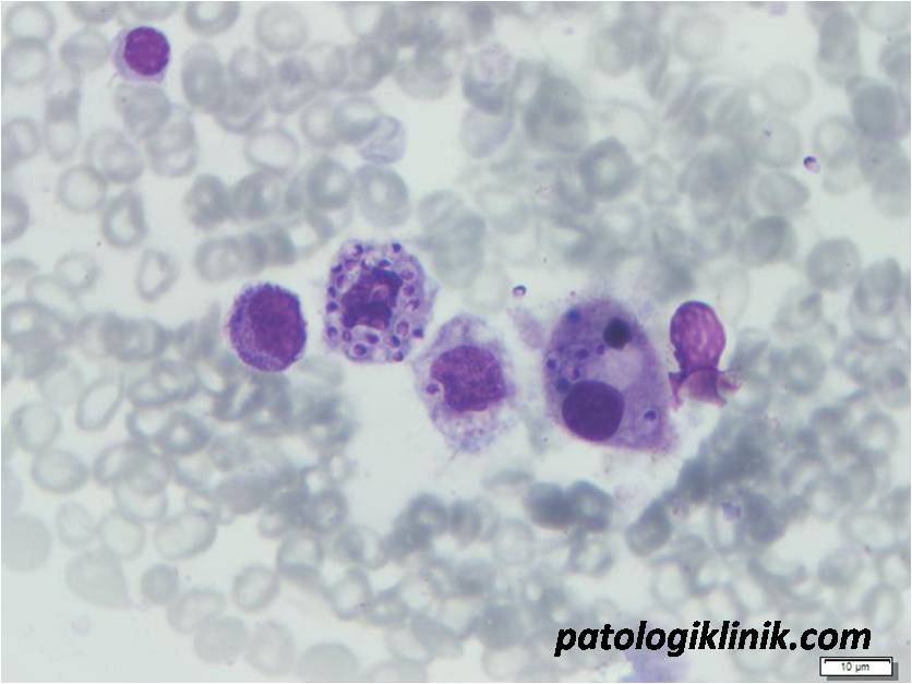 Histoplasma capsulatum di Sumsum Tulang