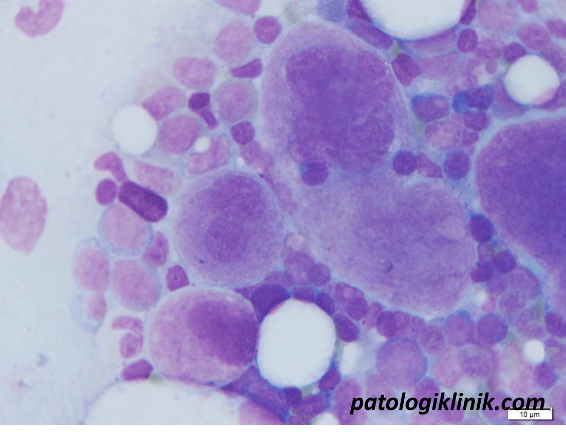 Gambaran Sumsum Tulang pada Myelodysplastic Syndrome (MDS)