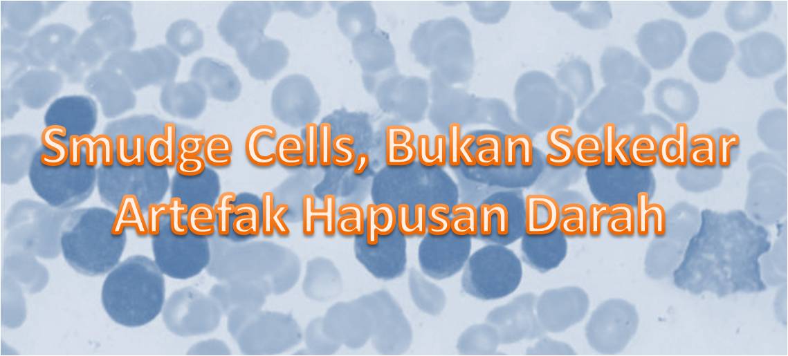 Smudge Cells, Bukan Sekedar Artefak Hapusan Darah