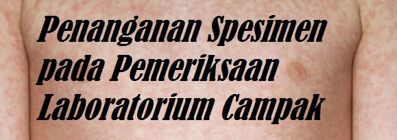 Penanganan Spesimen pada Pemeriksaan Laboratorium Campak