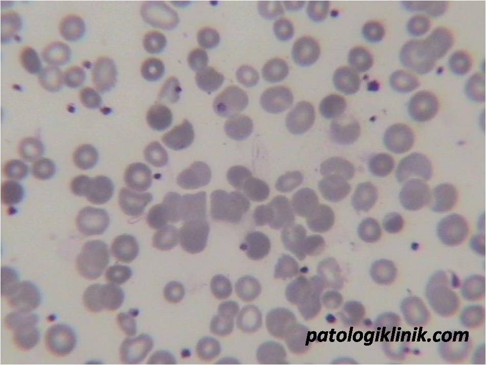 Gambaran Autoaglutinasi pada AIHA