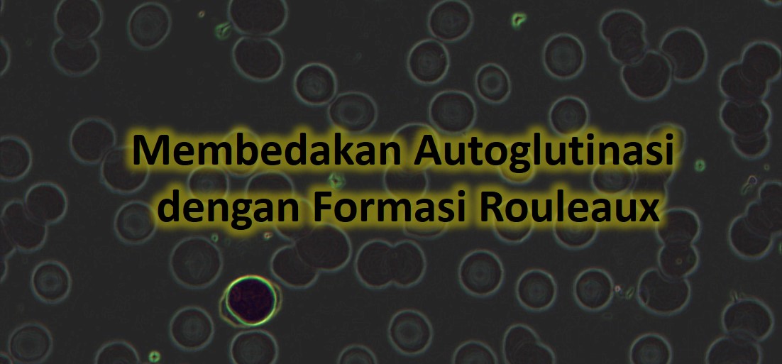 Membedakan Autoglutinasi dengan Formasi Rouleaux