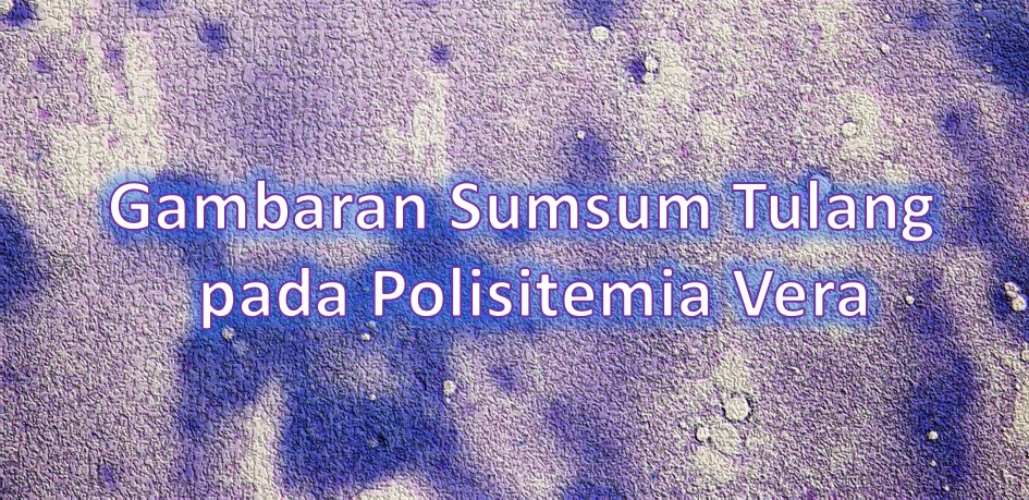 Gambaran Sumsum Tulang pada Polisitemia Vera