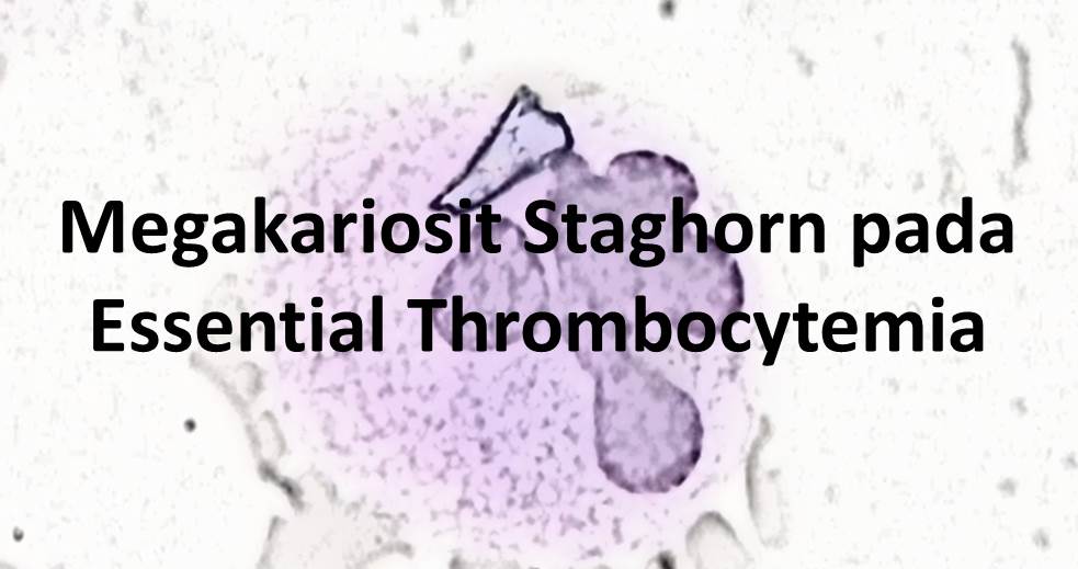 Megakariosit Staghorn pada Essential Thrombocytemia