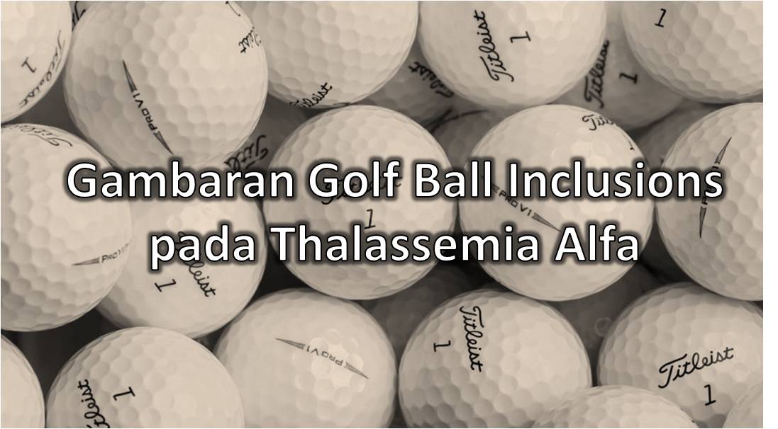 Gambaran Golf Ball Inclusion pada Thalassemia Alfa