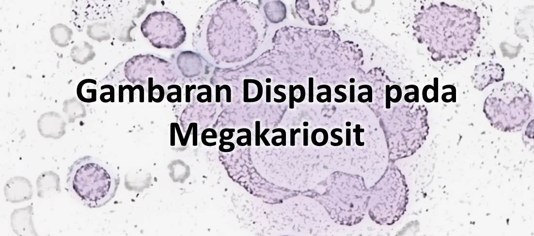 Gambaran Displasia pada Megakariosit
