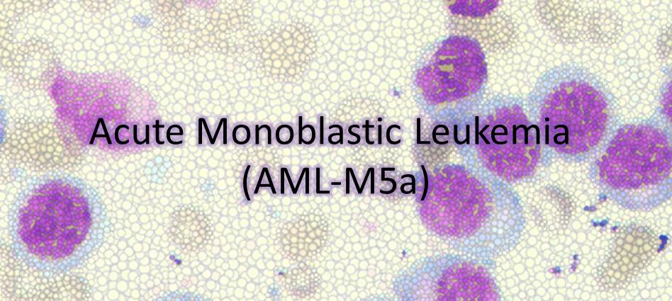 Acute Monoblastic Leukemia (AML-M5a)