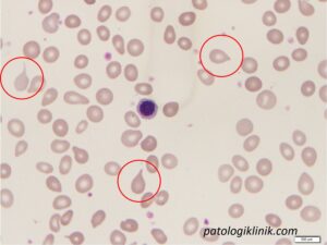 Gambaran Apusan Darah Tepi pada Mielofibrosis