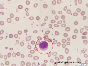 Gambaran Apusan Darah Tepi pada Mielofibrosis
