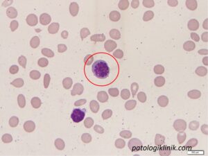 Gambaran Apusan Darah Tepi pada Mielofibrosis