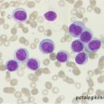 Acute Monoblastic Leukemia (AML-M5a)