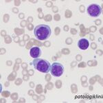 Acute Monoblastic Leukemia (AML-M5a)