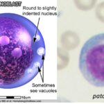Acute Monoblastic Leukemia (AML-M5a)