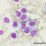 Acute Monoblastic Leukemia (AML-M5a)