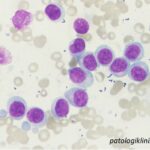 Acute Monoblastic Leukemia (AML-M5a)