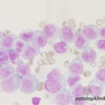 Acute Monoblastic Leukemia (AML-M5a)