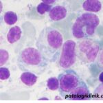 Sel Plasma dengan Badan Inklusi Kristaloid