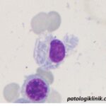 Sel Plasma dengan Badan Inklusi Kristaloid