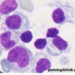 Sel Plasma dengan Badan Inklusi Kristaloid