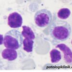 Sel Plasma dengan Badan Inklusi Kristaloid