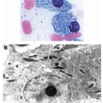 Sel Plasma dengan Badan Inklusi Kristaloid
